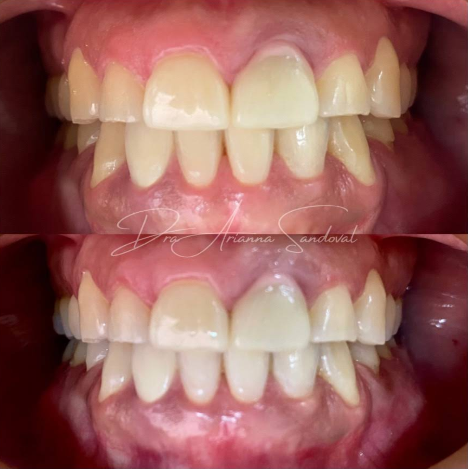 Caso de ortodoncia antes y después: corrección de mordida con brackets en Gud Dental Clinic
