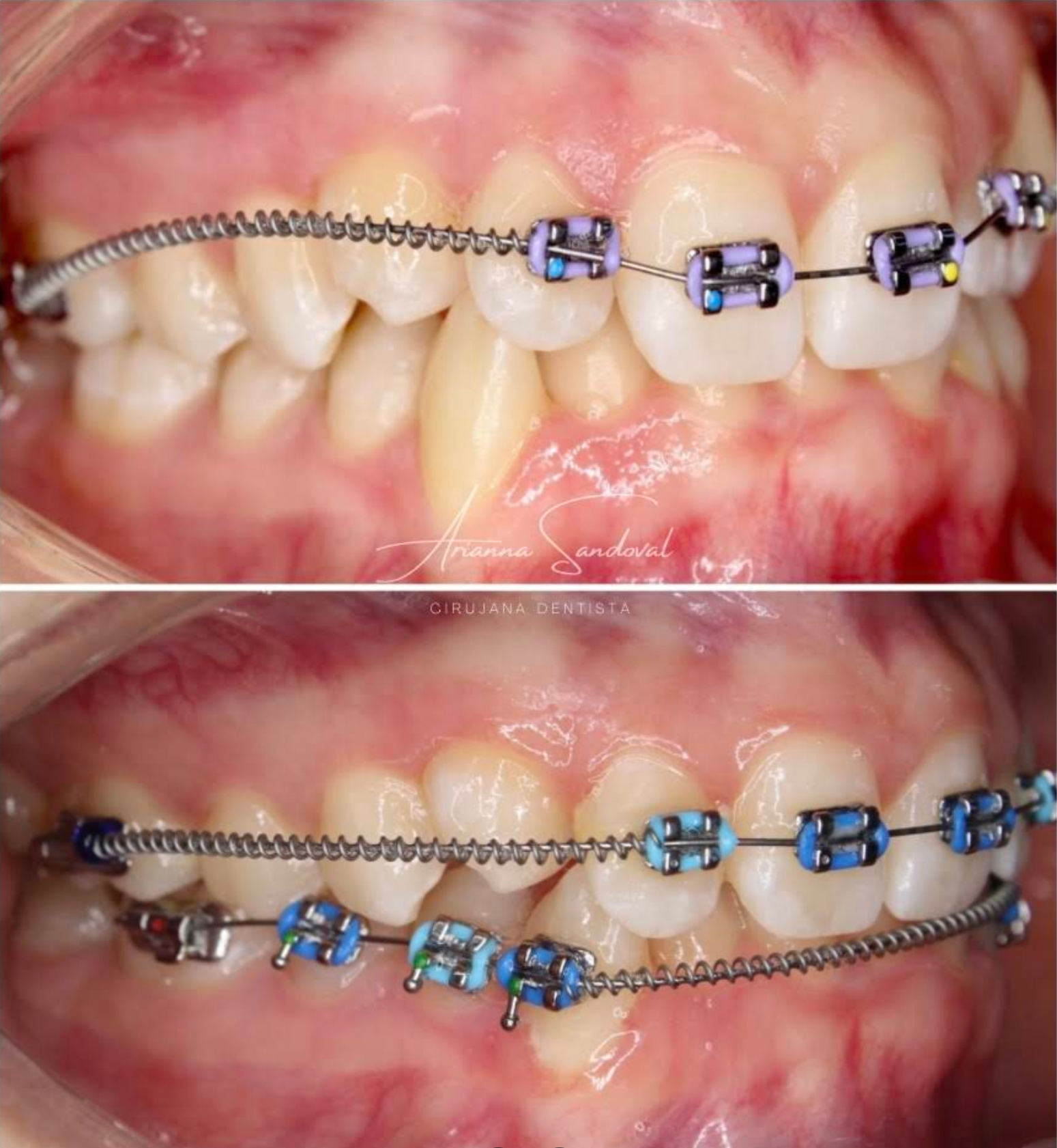 Resultado de tratamiento de ortodoncia: alineación dental completa en Gud Dental Clinic Tijuana