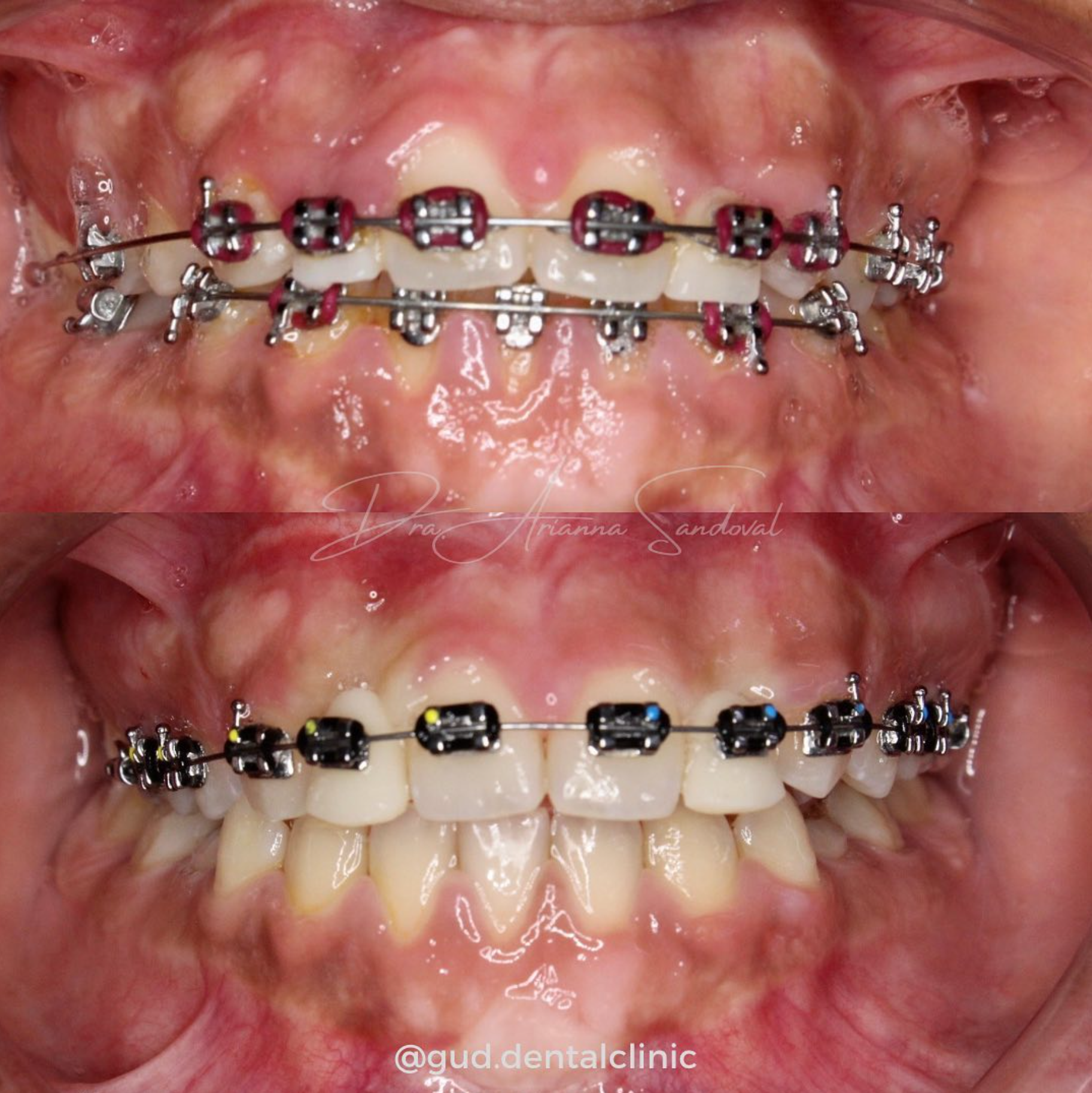 Transformación de sonrisa con ortodoncia: caso completado en Gud Dental Clinic